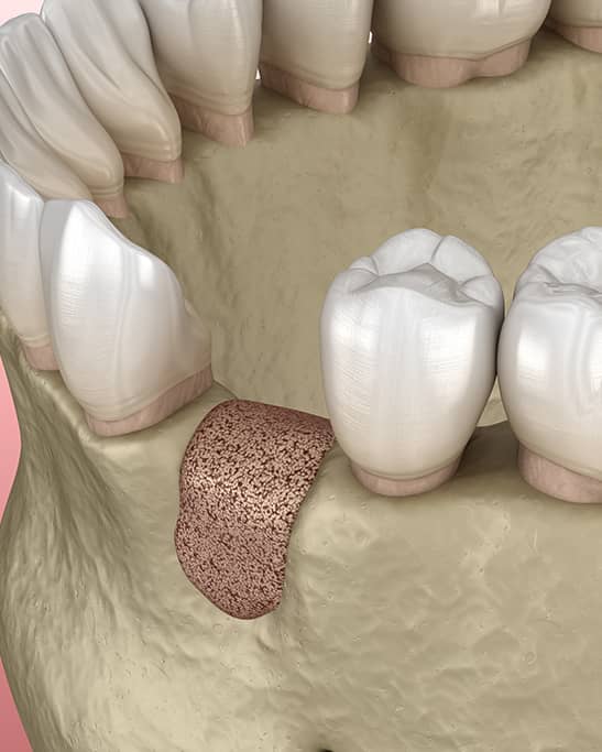 Greffe osseuse avant mise en place de la dent