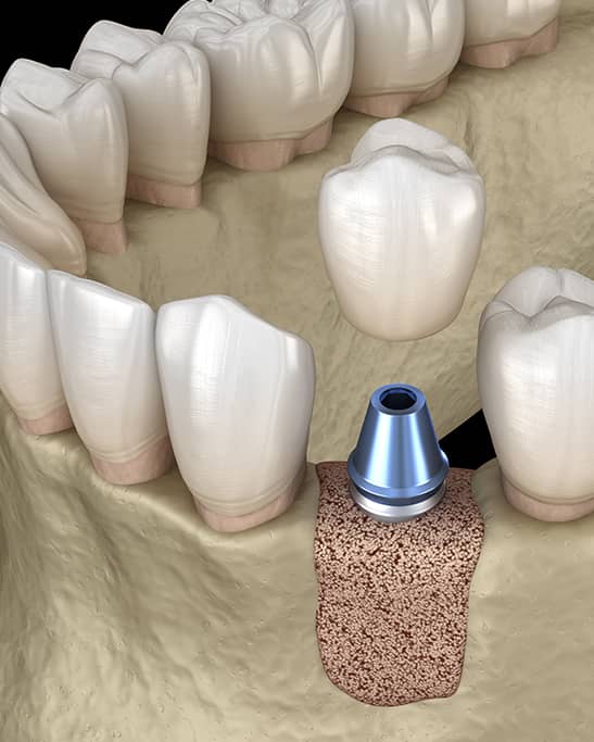 Greffe osseuse pendant la mise en place de la dent