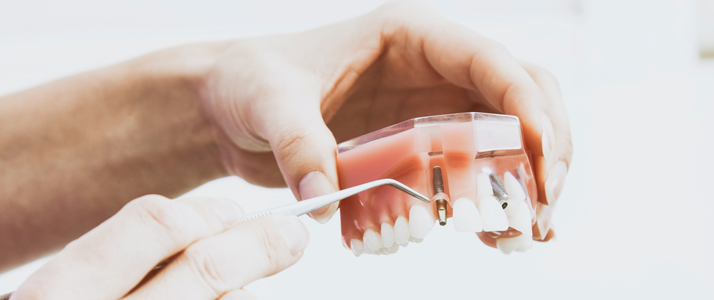 implant dentaire