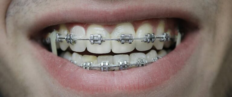 Alignement vs bagues