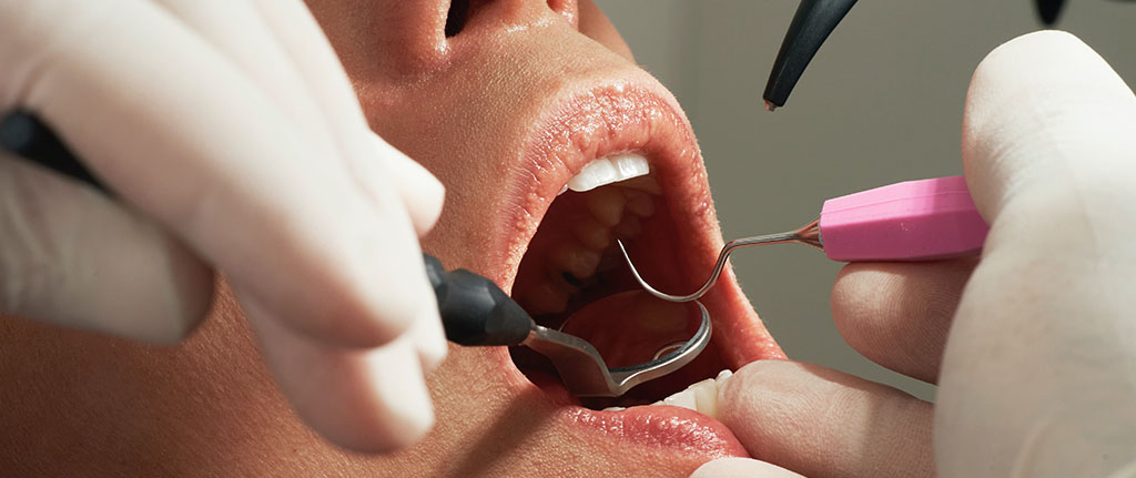Aligneur dentaire vs facettes dentaires